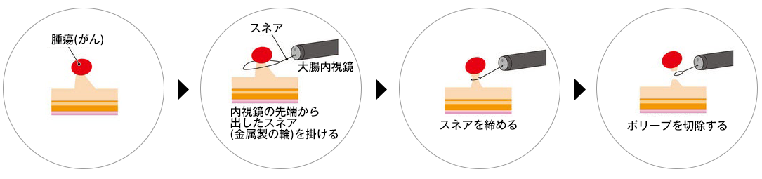 LASEREO7000システム